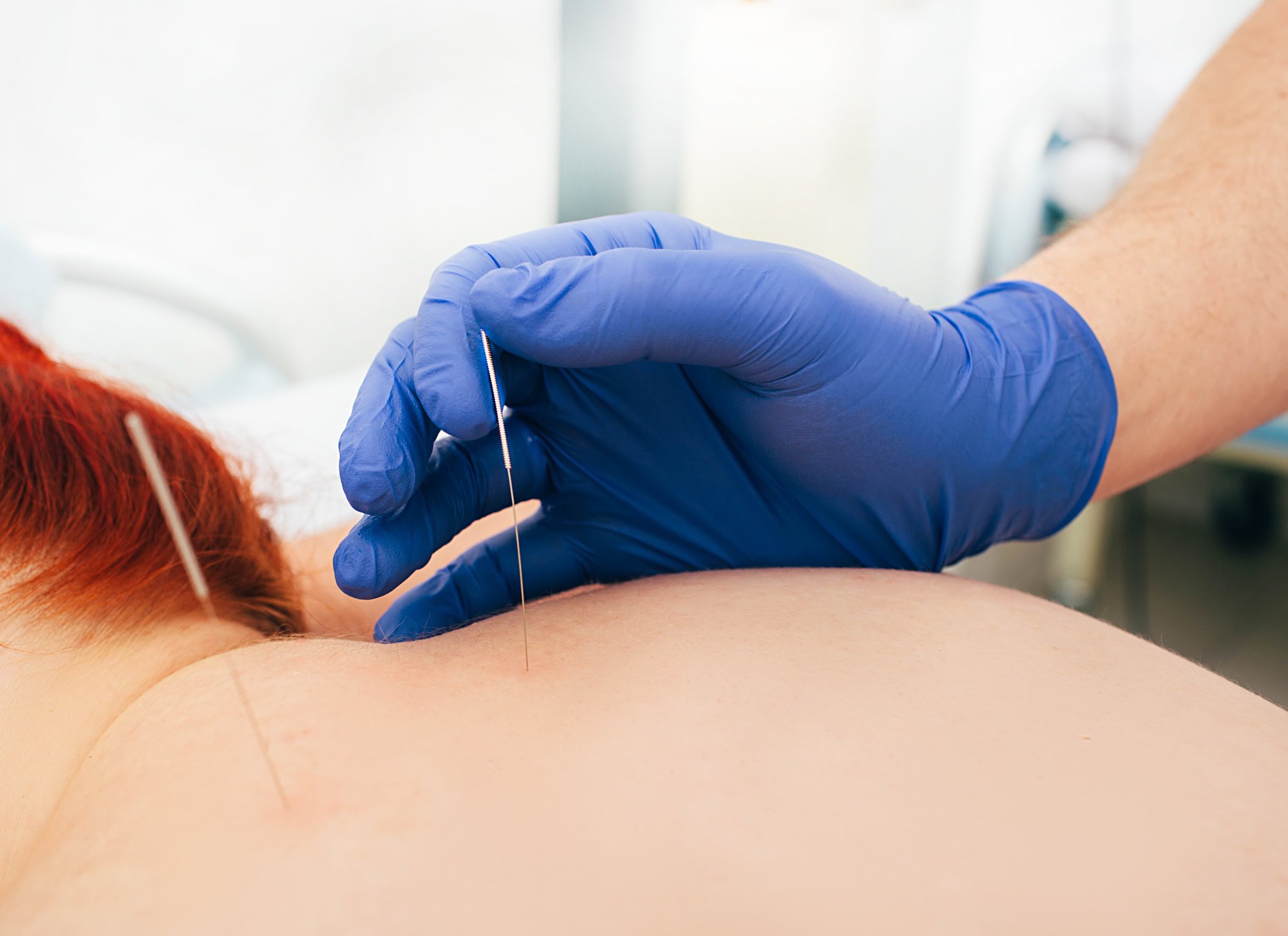 acupuncturist-inserting-a-needle-into-a-female-bac-2026-03-24-03-23-06-utc