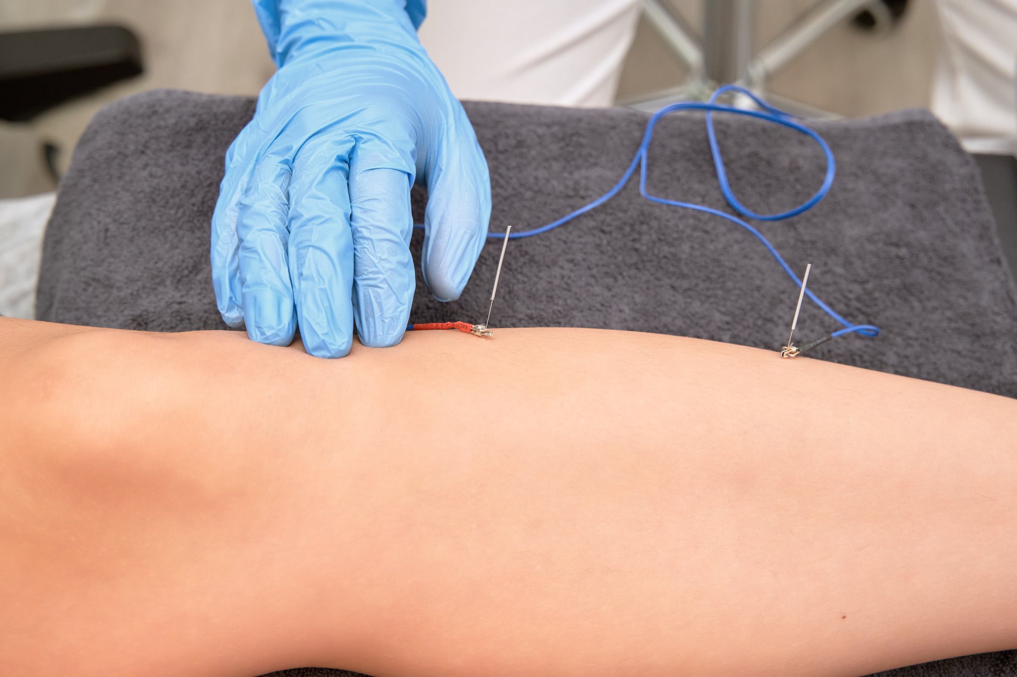 hands-of-physiotherapist-placing-electroacupunctur-2026-03-13-01-57-07-utc