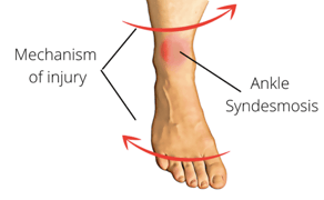 highanklesprain