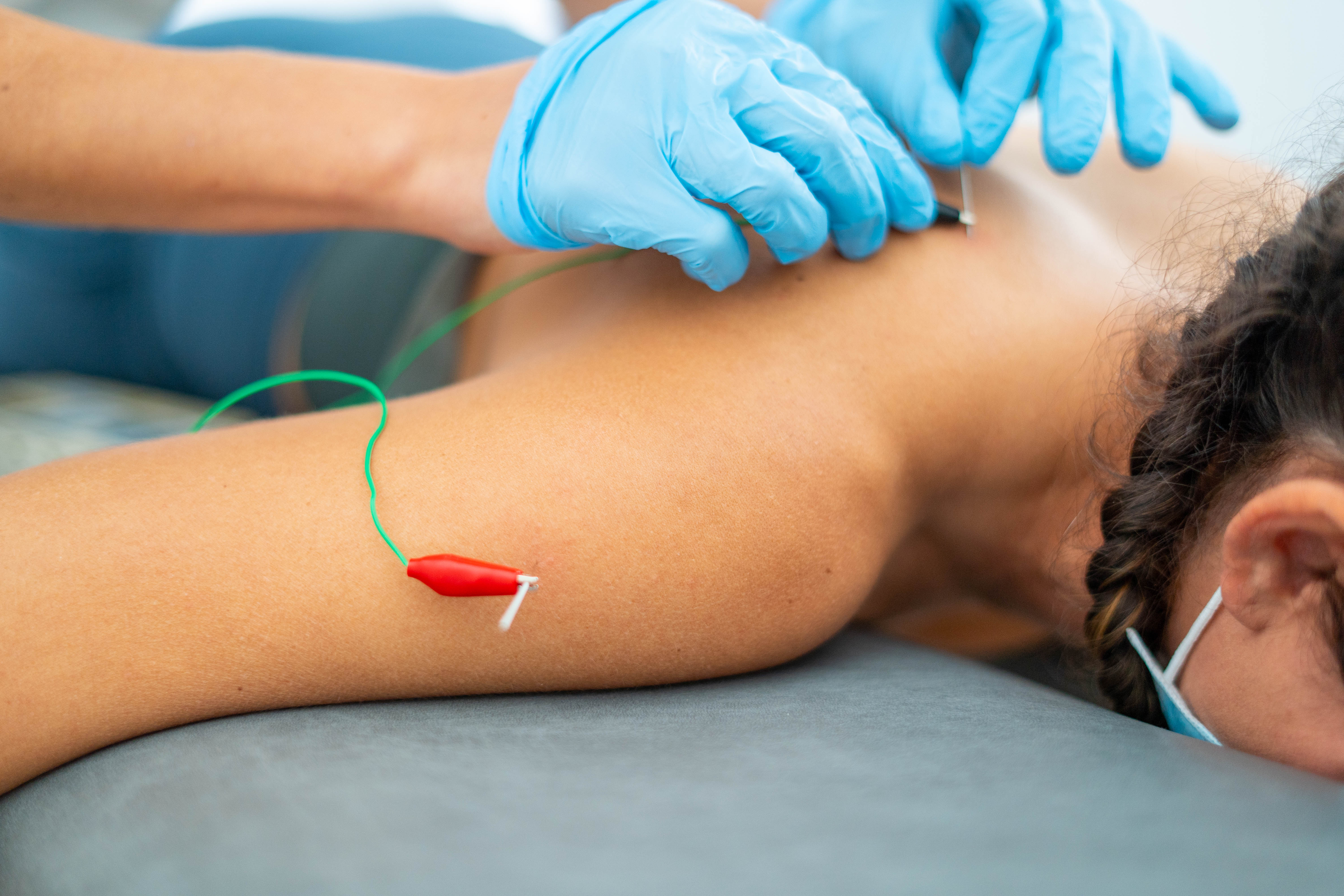 closeup-shot-of-a-doctor-putting-acupuncture-needl-2026-03-09-02-59-14-utc